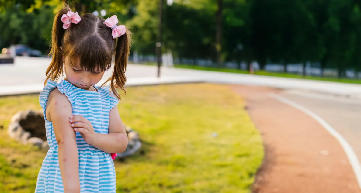 Manchas en la piel en niños